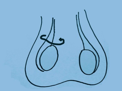 Torsion testiculaire - www.docteur-grima.com